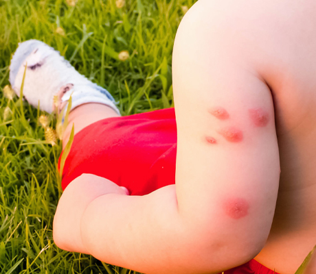 Has your child suffered a bite? Caladryl is the ideal aid in their care.