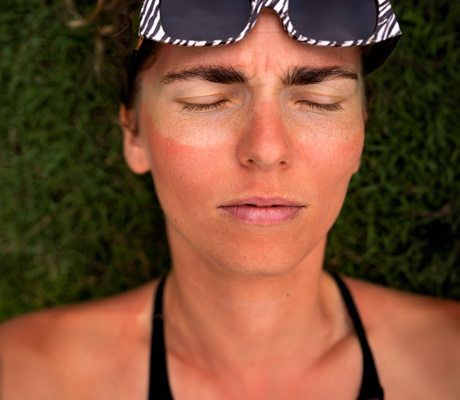 Caladryl Clear ® crema para quemaduras de sol