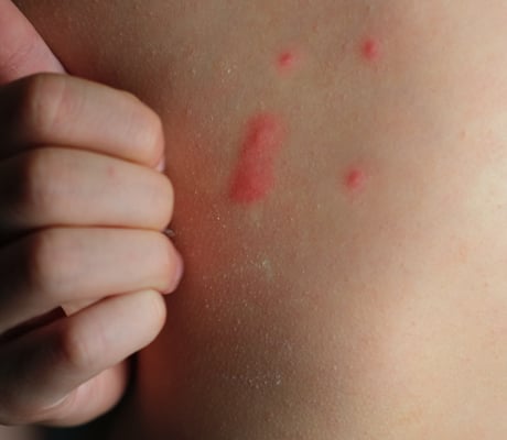 Hives on your children's skin