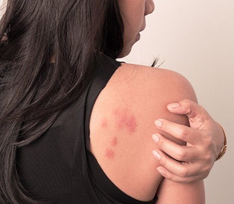 How to know what insect bit me